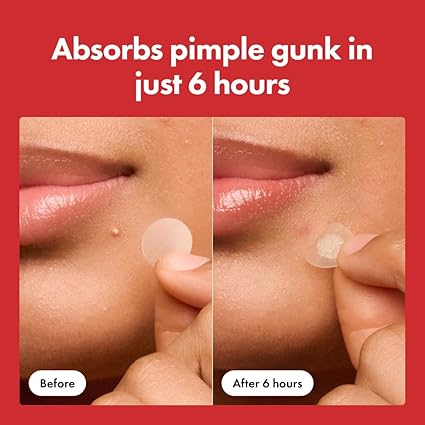 Mighty Patch™ Original – 36 Count | Hydrocolloid Acne Spot Stickers for Zits & Whiteheads | Hero Cosmetics Overnight Treatment